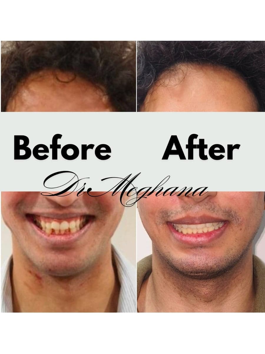 Crowding corrected with Invisalign clear aligners