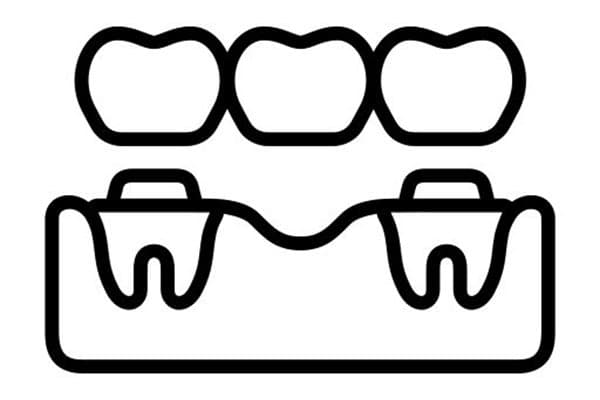 Crowns & Bridges