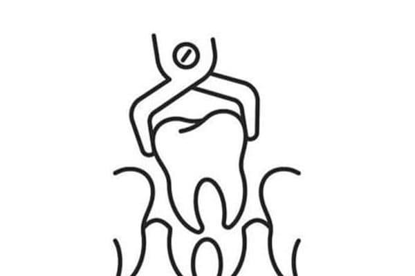 Tooth Extractions