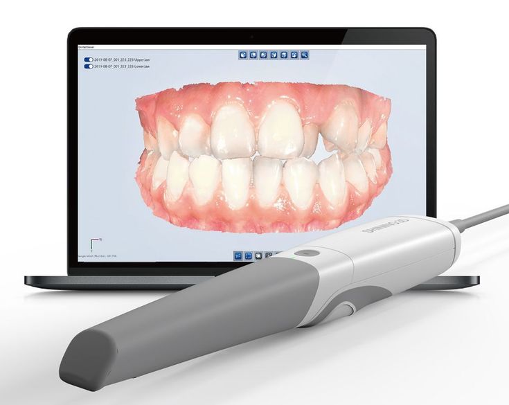 Aligners and Itero Scan at The Tooth Stop dental clinic