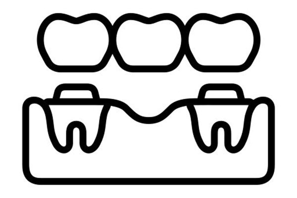 Crowns & Bridges